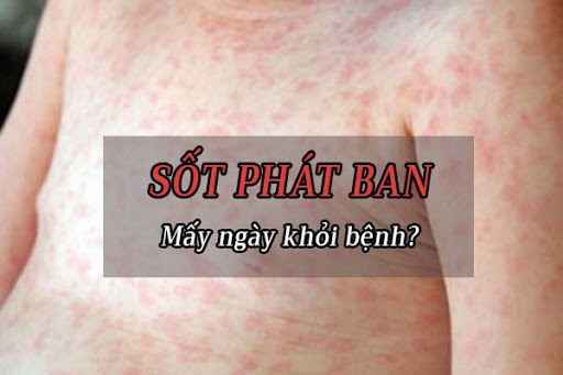 LƯU Ý CẦN BIẾT KHI ĐIỀU TRỊ SỐT PHÁT BAN TẠI NHÀ